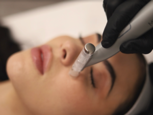 Vampire Facial - FCP Dermatology - FCP Dermatology Vampire Facial