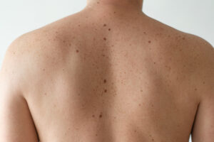 mole removal treatment - FCP Dermatology - FCP Dermatology mole removal treatment