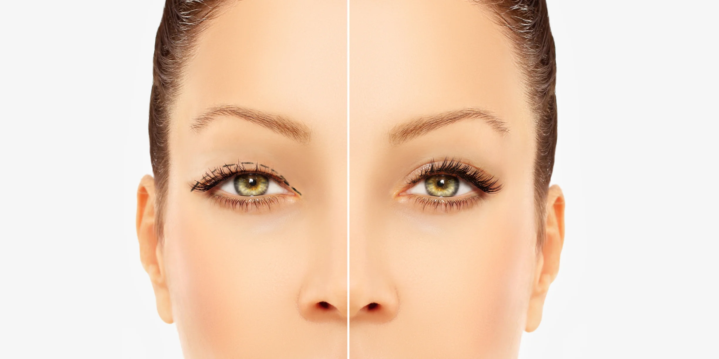 blepharoplasty surgery