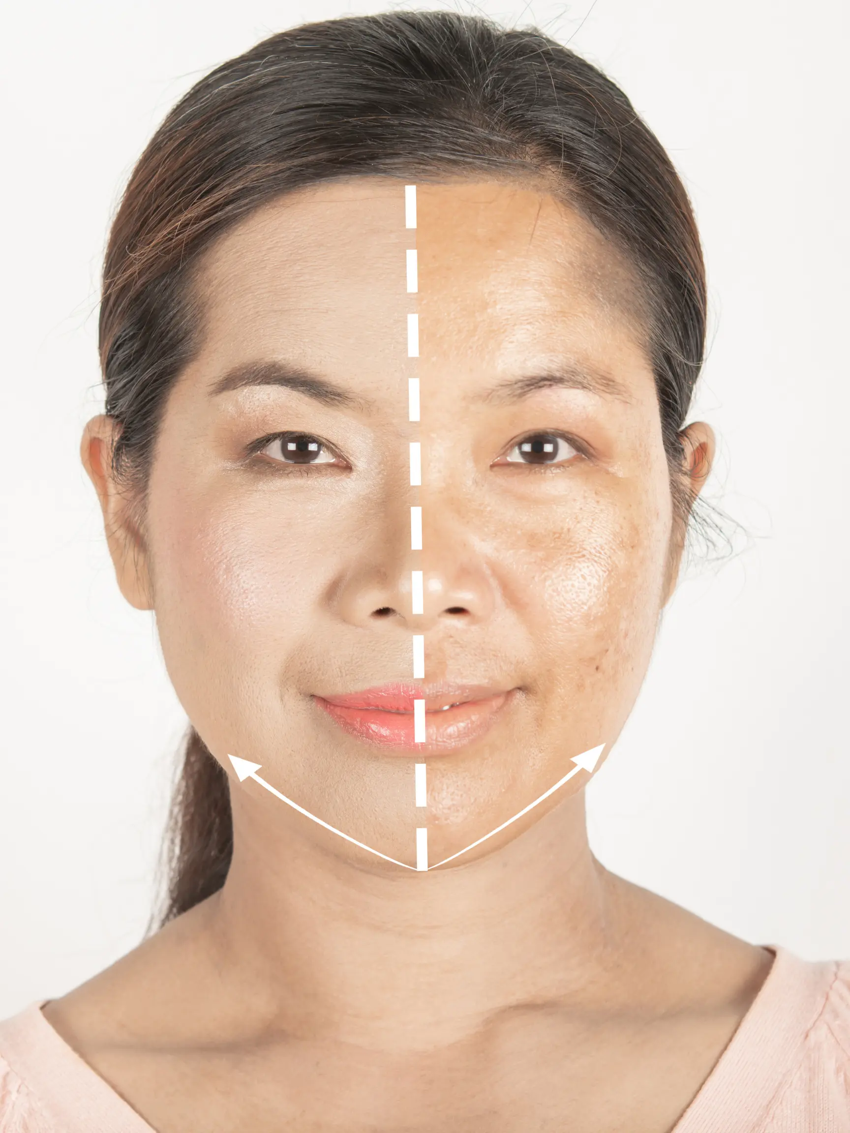 hyperpigmentation treatment