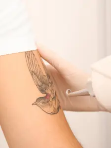 laser tattoo removal