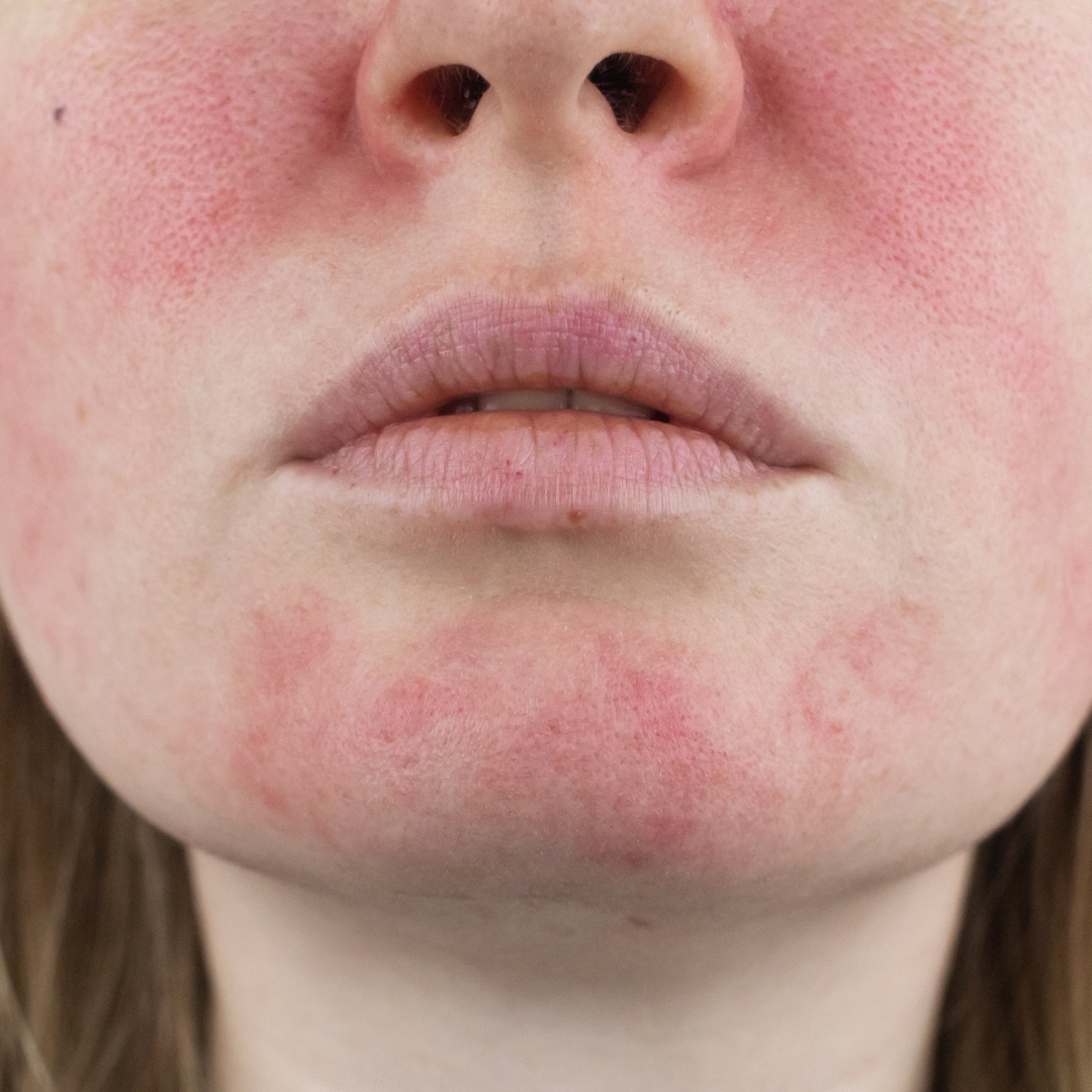 laser for rosacea treatments