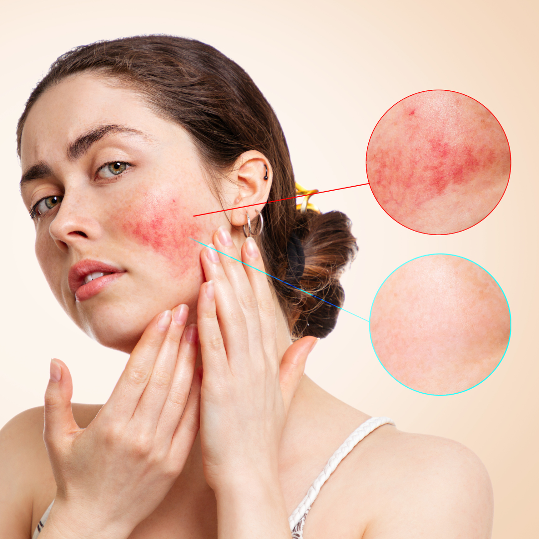 rosacea treatments