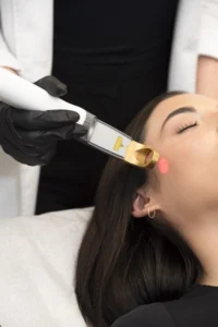 ExcelvLaser - FCP Dermatology - FCP Dermatology Rosacea Excel V Laser