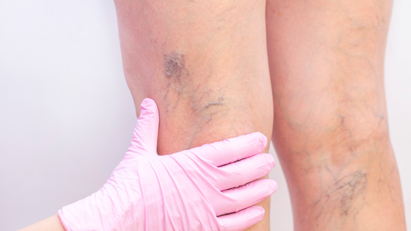 spider vein treatment toronto