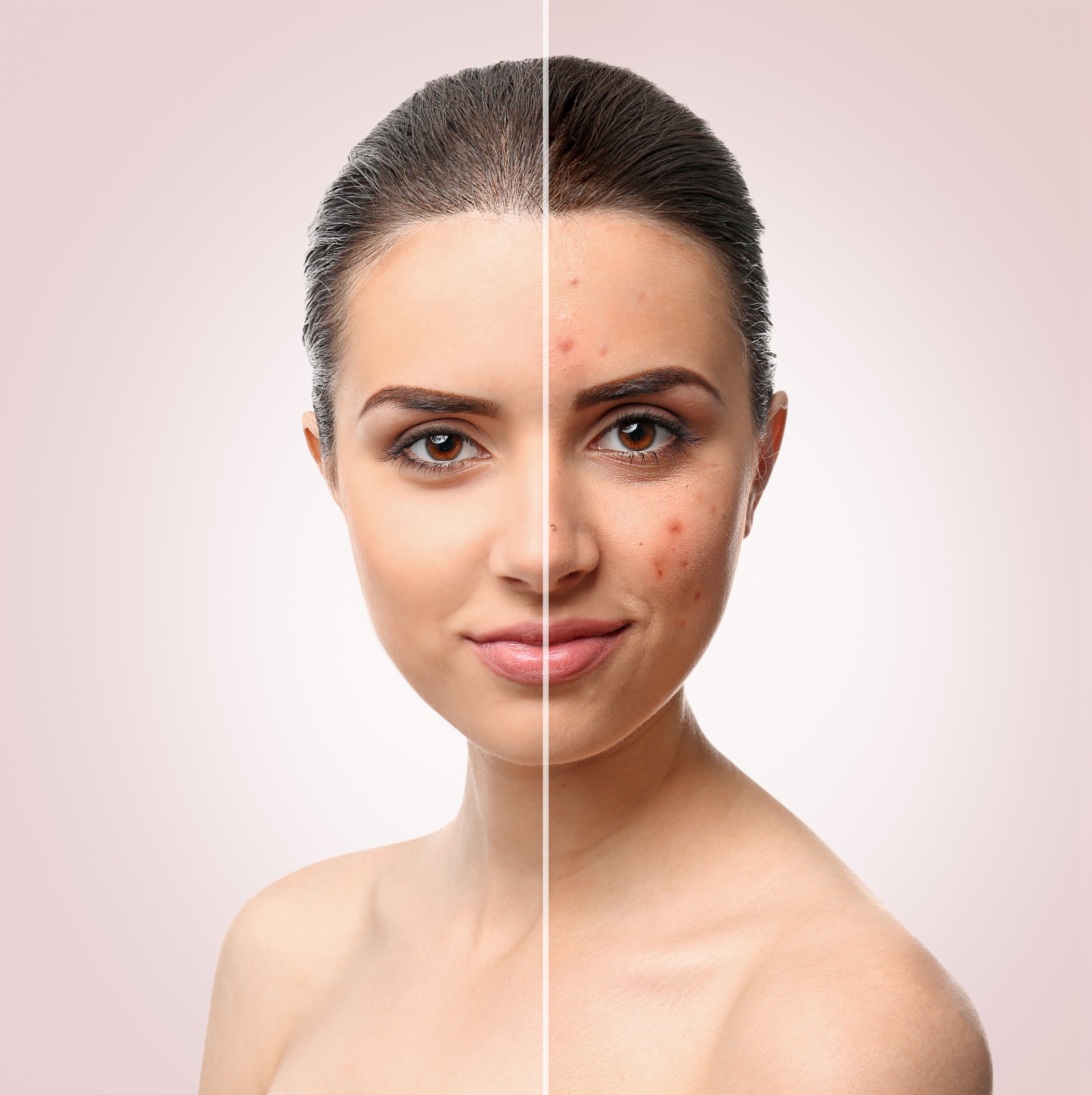 acne treatment toronto