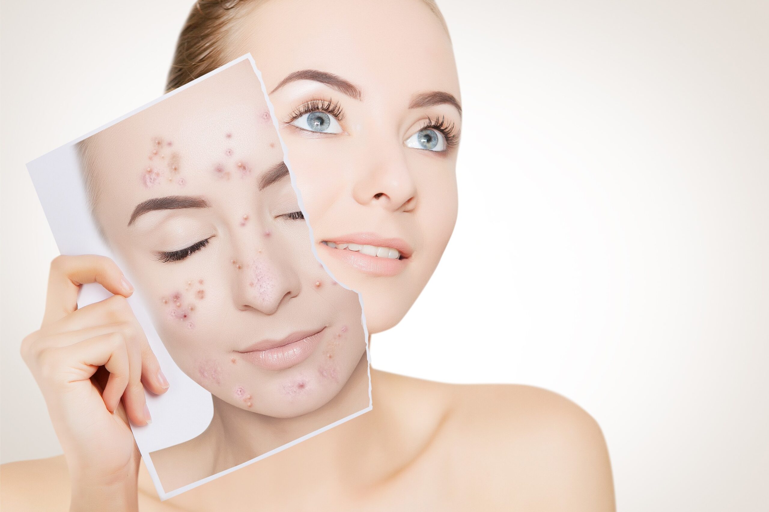 acne scar removal toronto