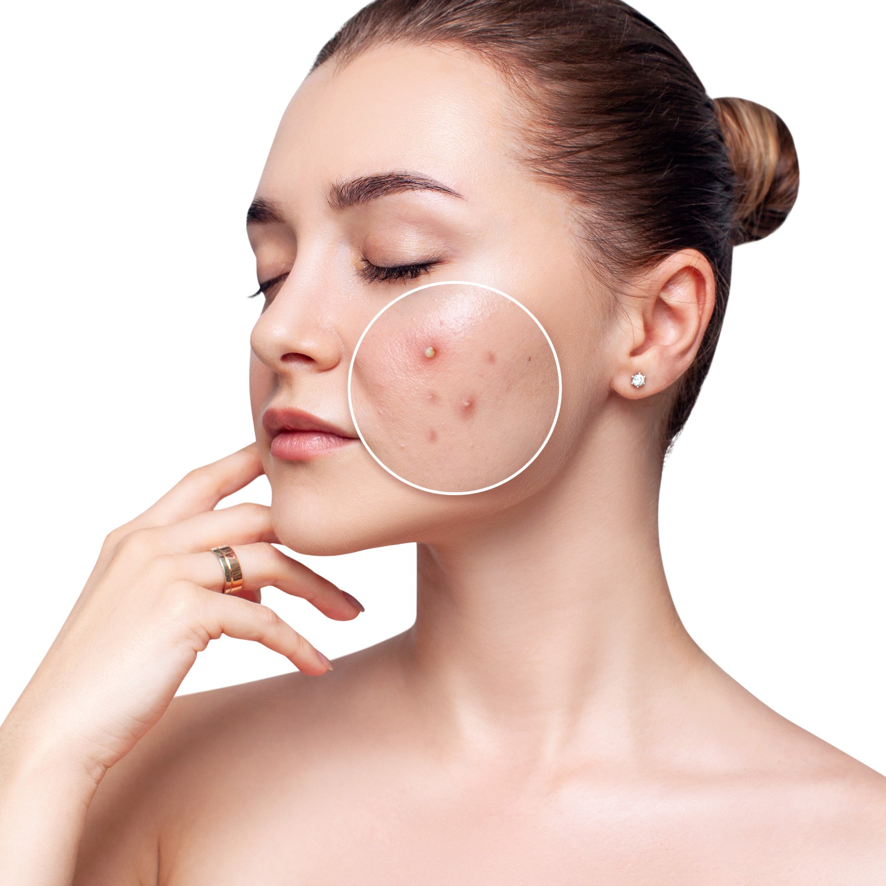 acne scarring treatment