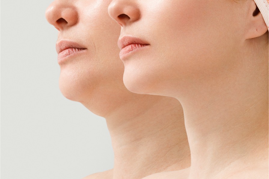 Double Chin and neck fat reduction