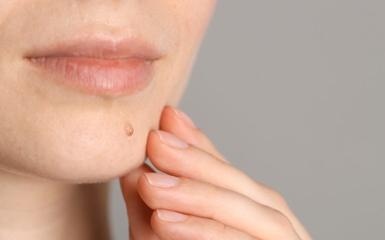 Skin tag removal treatment