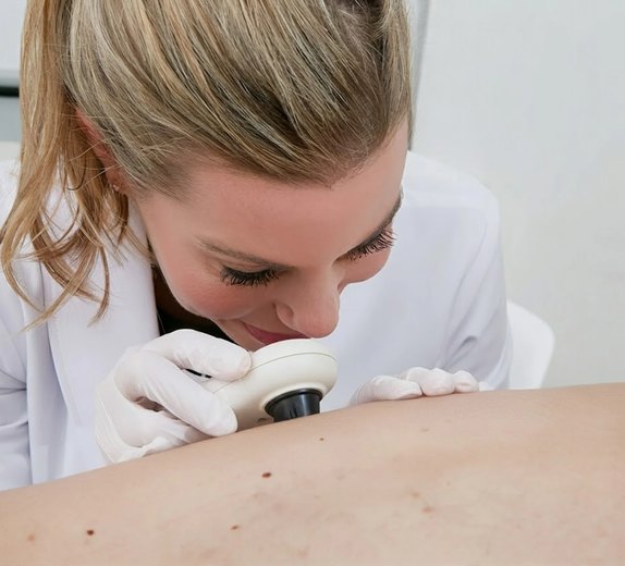 Dermatologist examining a patient’s skin with a dermatoscope before a cyst removal