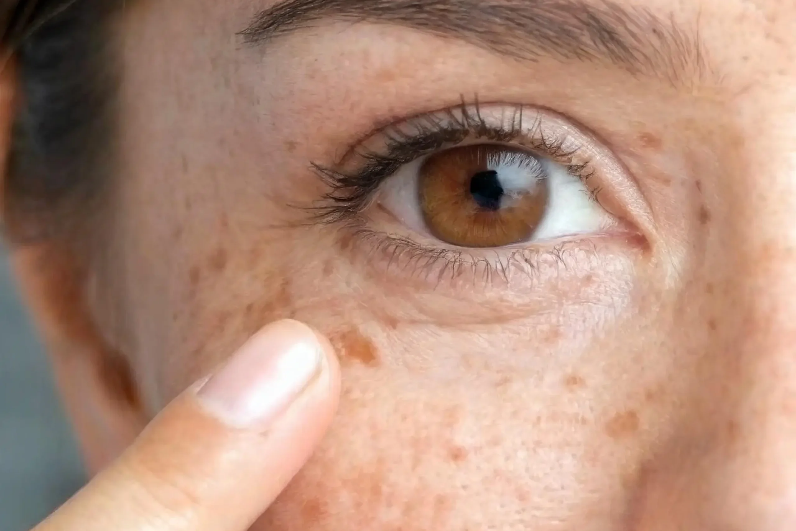 age spots removal