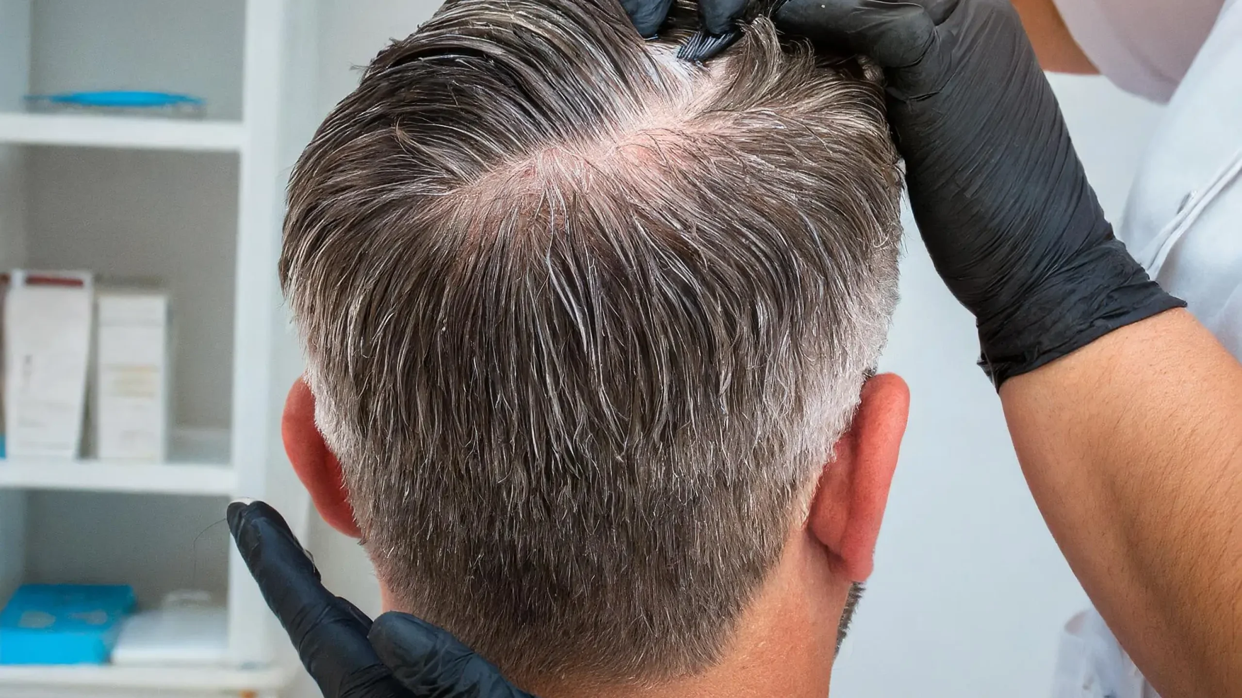 crown hair transplant