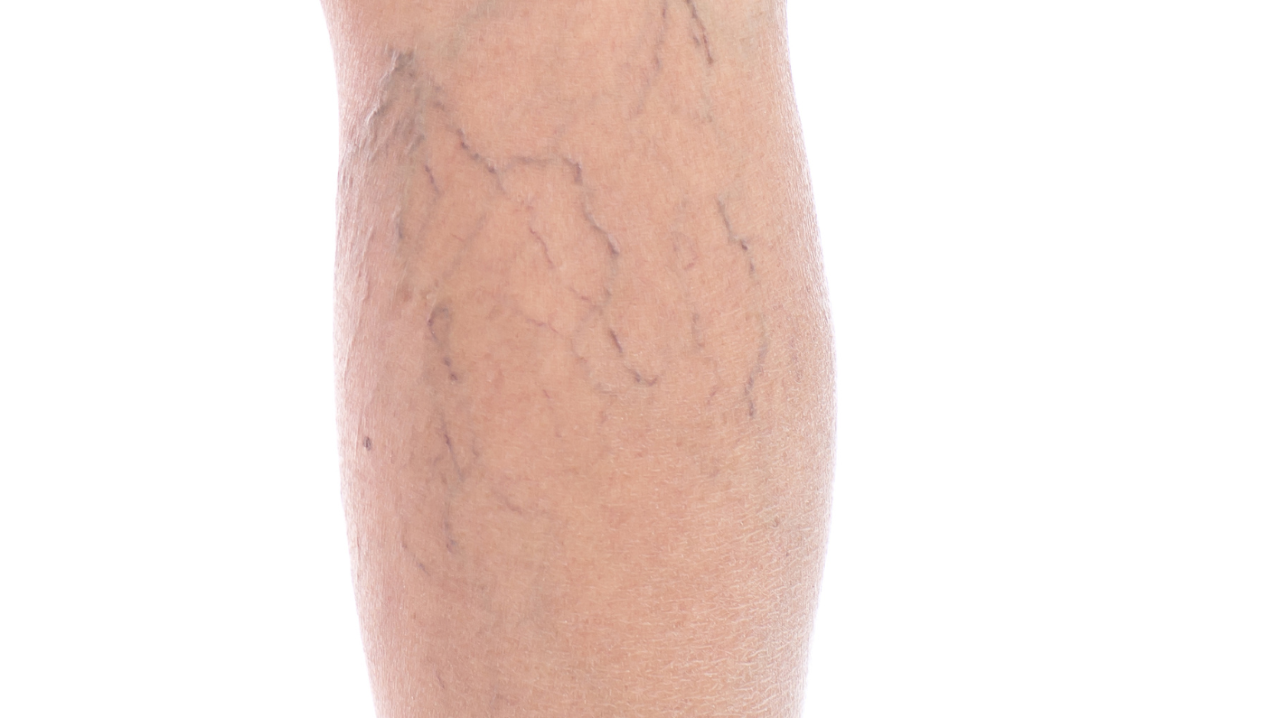 sclerotherapy near me