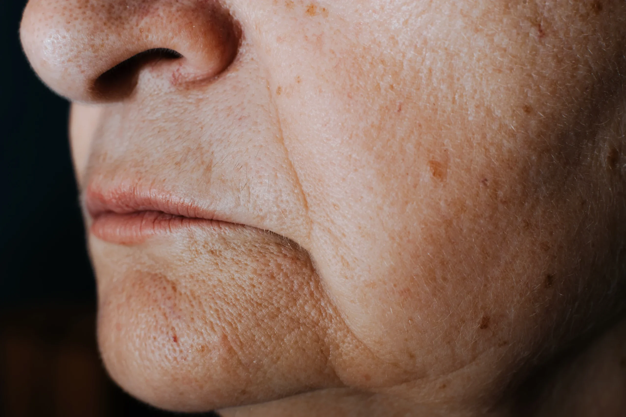 age spots removal toronto